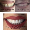 دندانپزشک تهران  - ملاصدرا 02188032805 انواع ایمپلنت و کاشت دندان ، روکش دندان برای زیبایی ، پرکردن دندان